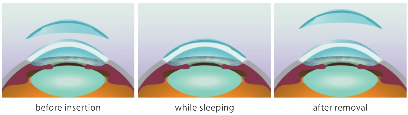 The Lens and cornea before insertion, while sleeping and after removal